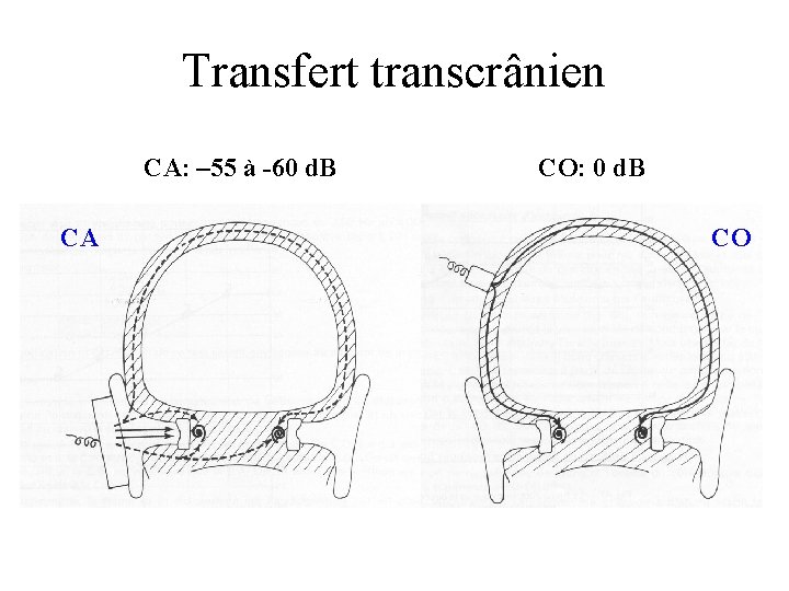 Transfert transcrânien CA: – 55 à -60 d. B CA CO: 0 d. B