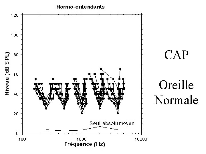 CAP Oreille Normale 