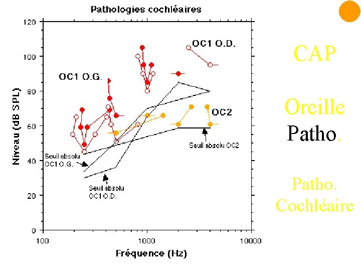 CAP Oreille Patho. Cochléaire 