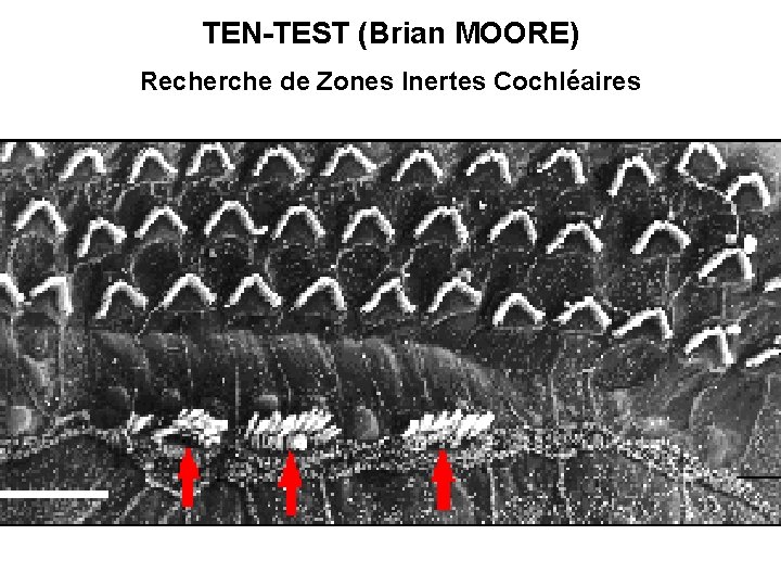 TEN-TEST (Brian MOORE) Recherche de Zones Inertes Cochléaires 