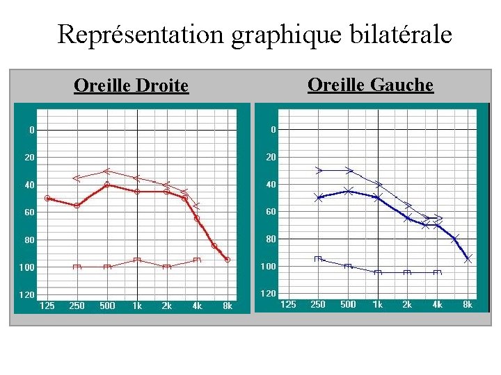 Représentation graphique bilatérale Oreille Droite Oreille Gauche 