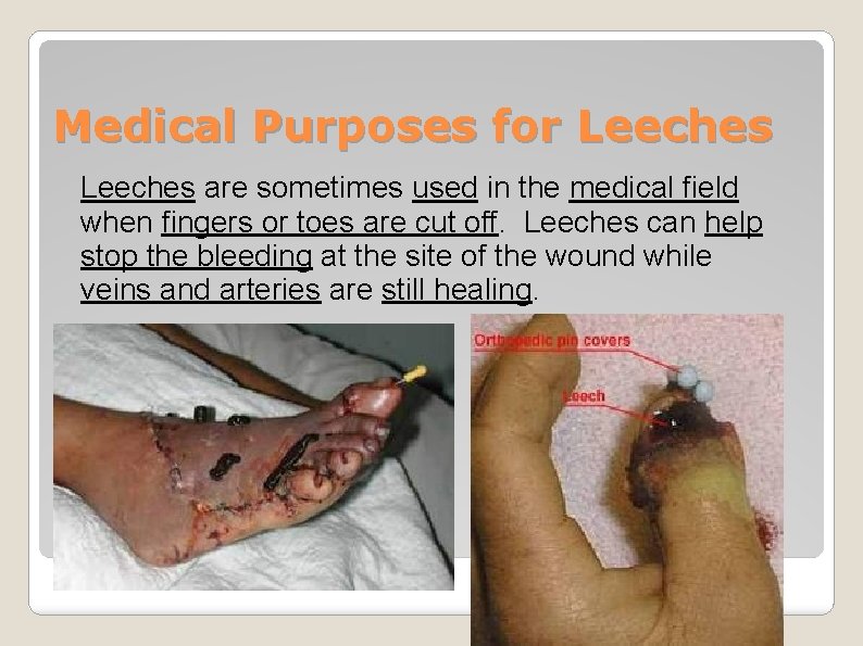 Medical Purposes for Leeches are sometimes used in the medical field when fingers or