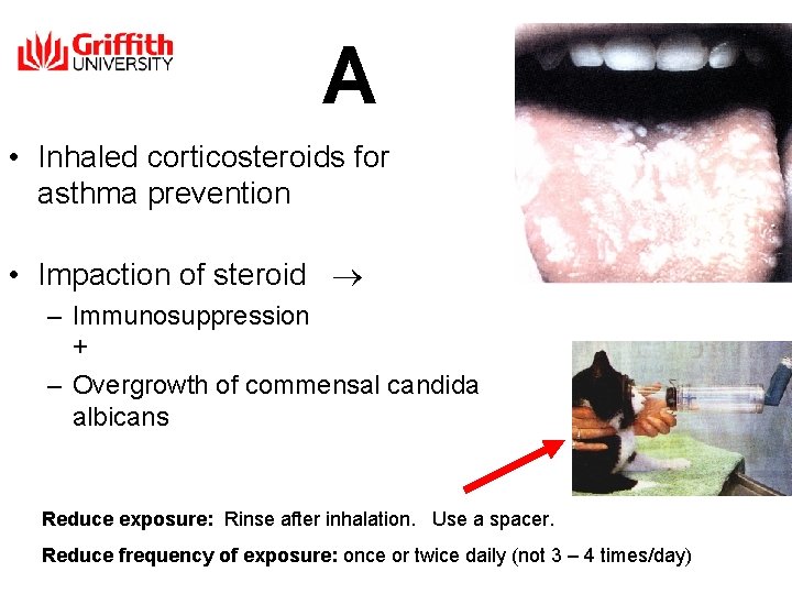 A • Inhaled corticosteroids for asthma prevention • Impaction of steroid – Immunosuppression +