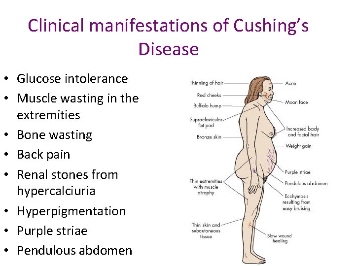 Clinical manifestations of Cushing’s Disease • Glucose intolerance • Muscle wasting in the extremities