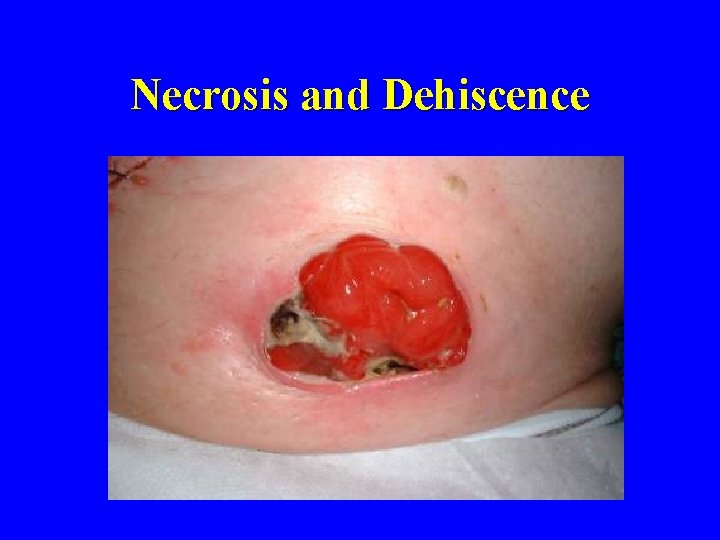 Necrosis and Dehiscence 