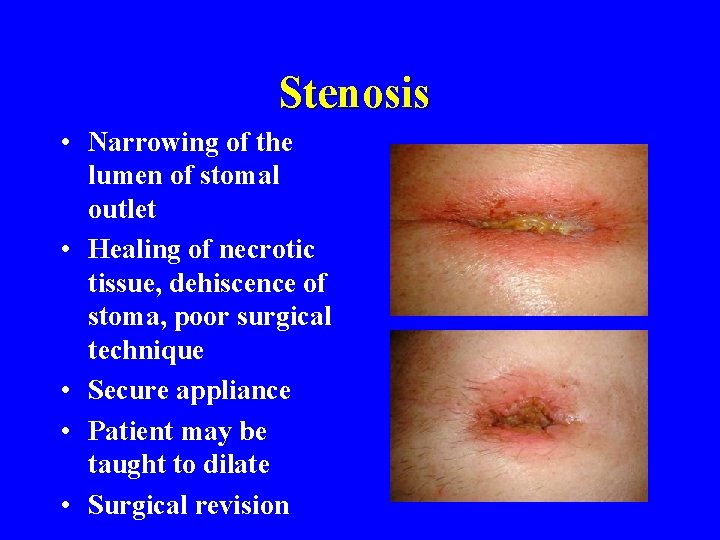 Stenosis • Narrowing of the lumen of stomal outlet • Healing of necrotic tissue,