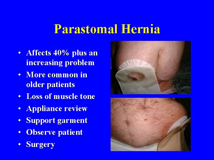 Parastomal Hernia • Affects 40% plus an increasing problem • More common in older