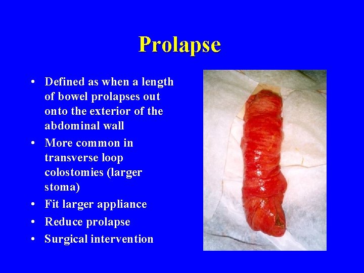 Prolapse • Defined as when a length of bowel prolapses out onto the exterior