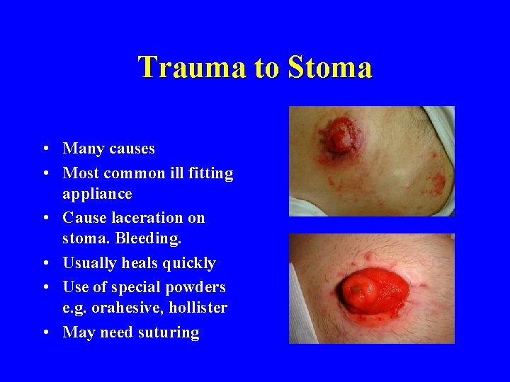 Trauma to Stoma • Many causes • Most common ill fitting appliance • Cause