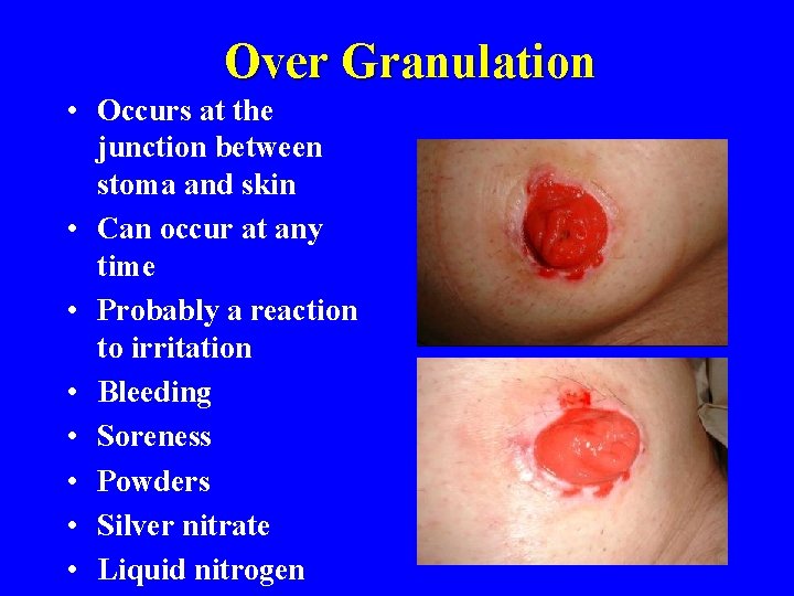 Over Granulation • Occurs at the junction between stoma and skin • Can occur