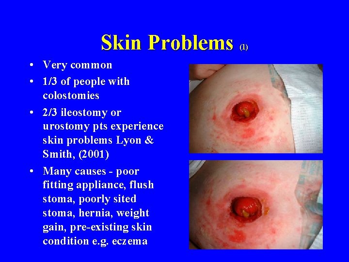 Skin Problems • Very common • 1/3 of people with colostomies • 2/3 ileostomy