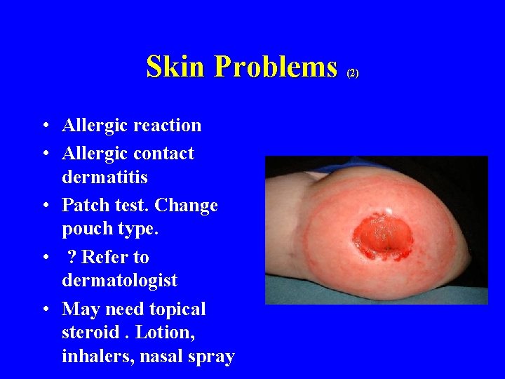 Skin Problems • Allergic reaction • Allergic contact dermatitis • Patch test. Change pouch