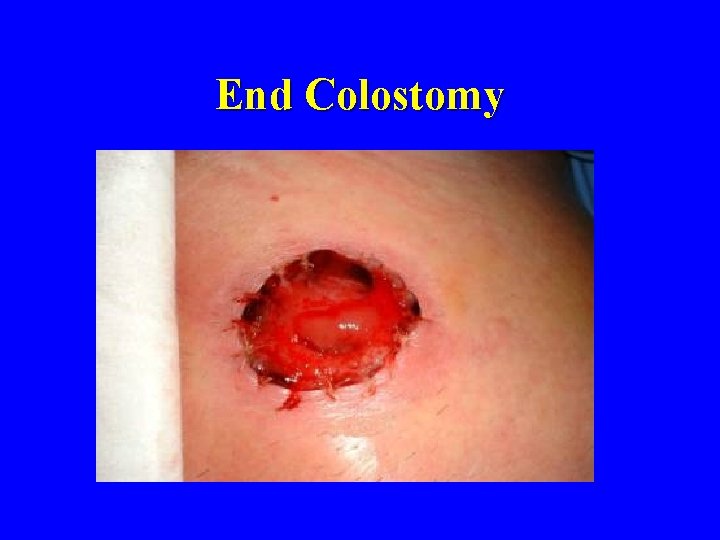 End Colostomy 