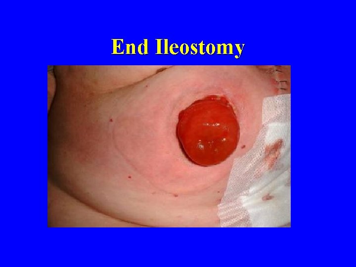 End Ileostomy 