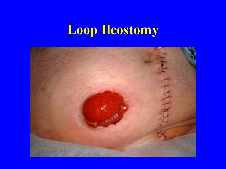 Loop Ileostomy 