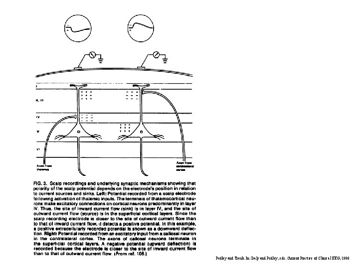 Pedley and Traub. In: Daly and Pedley, eds. Current Practice of Clinical EEG, 1990 Pedley and Traub. In: Daly and Pedley, eds. Current Practice of Clinical EEG, 1990