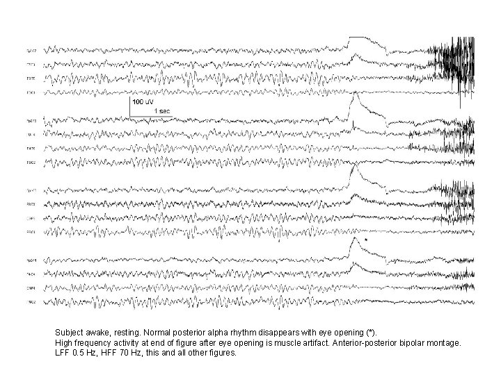 Subject awake, resting. Normal posterior alpha rhythm disappears with eye opening (*). High frequency Subject awake, resting. Normal posterior alpha rhythm disappears with eye opening (*). High frequency