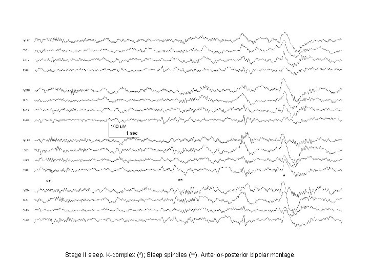 Stage II sleep. K-complex (*); Sleep spindles (**). Anterior-posterior bipolar montage. Stage II sleep. K-complex (*); Sleep spindles (**). Anterior-posterior bipolar montage.