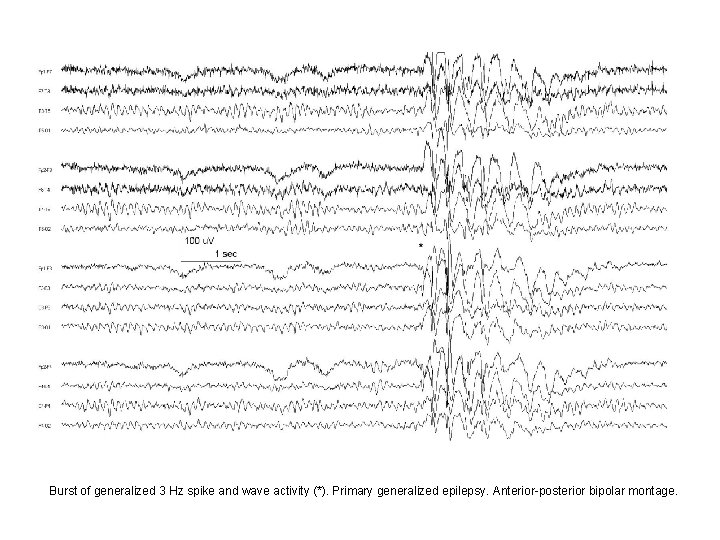 Burst of generalized 3 Hz spike and wave activity (*). Primary generalized epilepsy. Anterior-posterior Burst of generalized 3 Hz spike and wave activity (*). Primary generalized epilepsy. Anterior-posterior