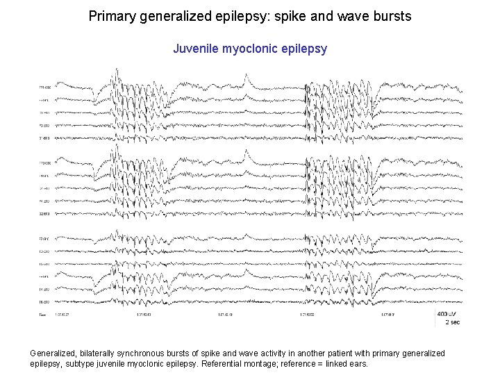Primary generalized epilepsy: spike and wave bursts Juvenile myoclonic epilepsy Generalized, bilaterally synchronous bursts Primary generalized epilepsy: spike and wave bursts Juvenile myoclonic epilepsy Generalized, bilaterally synchronous bursts