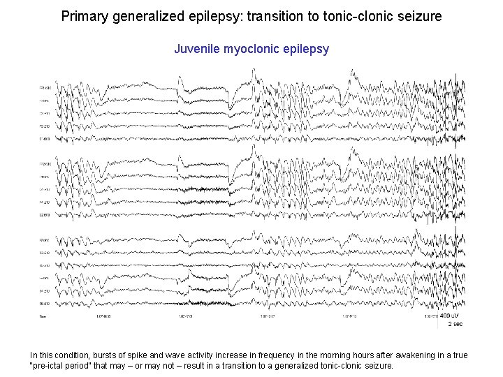 Primary generalized epilepsy: transition to tonic-clonic seizure Juvenile myoclonic epilepsy In this condition, bursts Primary generalized epilepsy: transition to tonic-clonic seizure Juvenile myoclonic epilepsy In this condition, bursts