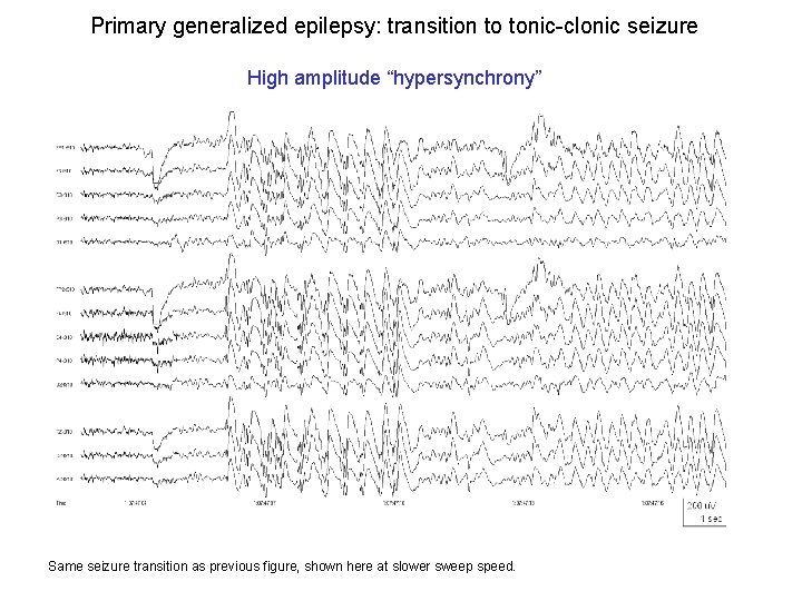 Primary generalized epilepsy: transition to tonic-clonic seizure High amplitude “hypersynchrony” Same seizure transition as Primary generalized epilepsy: transition to tonic-clonic seizure High amplitude “hypersynchrony” Same seizure transition as