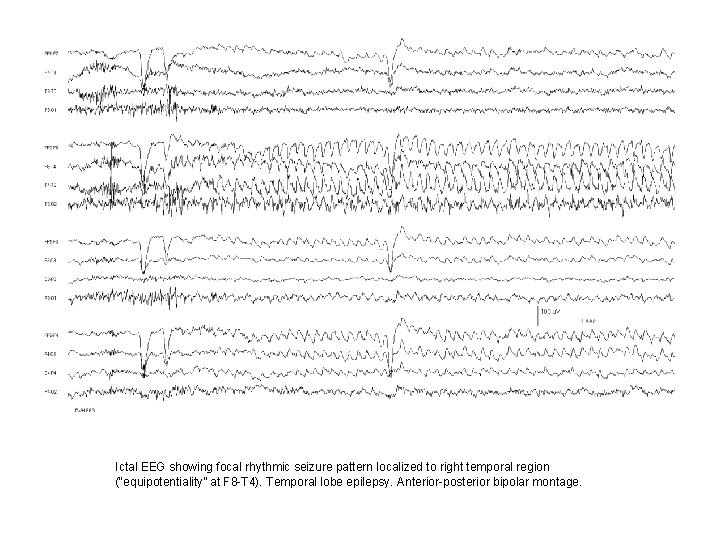 Ictal EEG showing focal rhythmic seizure pattern localized to right temporal region (“equipotentiality” at Ictal EEG showing focal rhythmic seizure pattern localized to right temporal region (“equipotentiality” at
