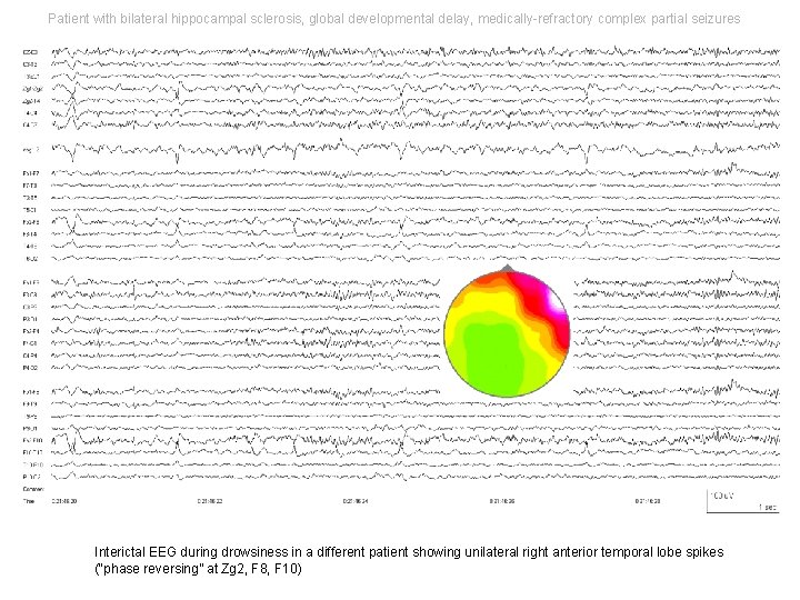 Patient with bilateral hippocampal sclerosis, global developmental delay, medically-refractory complex partial seizures Interictal EEG Patient with bilateral hippocampal sclerosis, global developmental delay, medically-refractory complex partial seizures Interictal EEG