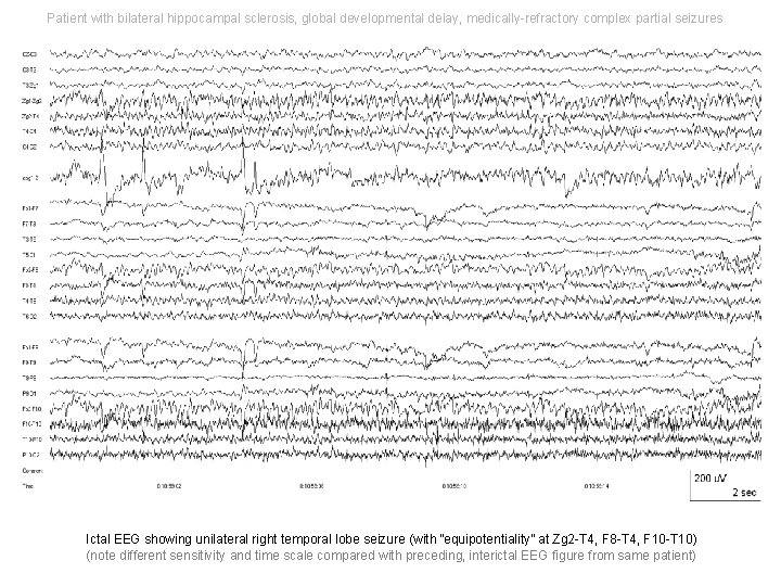 Patient with bilateral hippocampal sclerosis, global developmental delay, medically-refractory complex partial seizures Ictal EEG Patient with bilateral hippocampal sclerosis, global developmental delay, medically-refractory complex partial seizures Ictal EEG