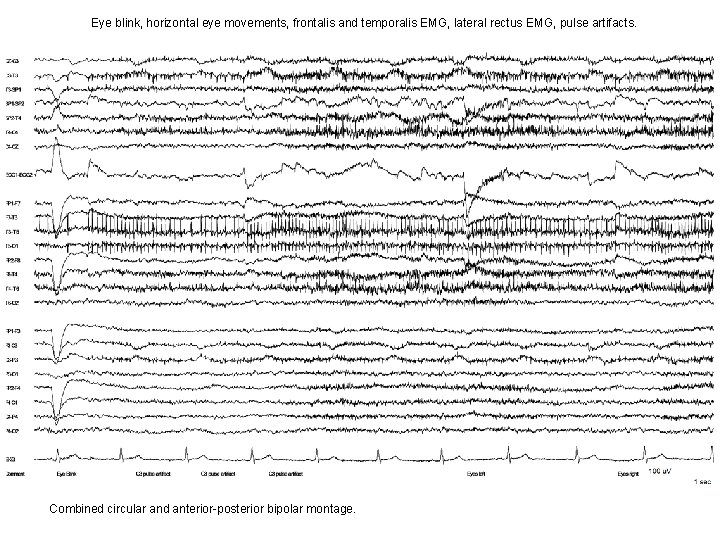 Eye blink, horizontal eye movements, frontalis and temporalis EMG, lateral rectus EMG, pulse artifacts. Eye blink, horizontal eye movements, frontalis and temporalis EMG, lateral rectus EMG, pulse artifacts.