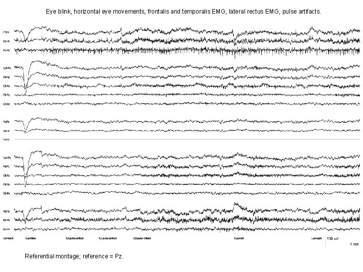 Eye blink, horizontal eye movements, frontalis and temporalis EMG, lateral rectus EMG, pulse artifacts. Eye blink, horizontal eye movements, frontalis and temporalis EMG, lateral rectus EMG, pulse artifacts.