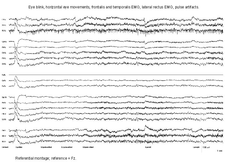 Eye blink, horizontal eye movements, frontalis and temporalis EMG, lateral rectus EMG, pulse artifacts. Eye blink, horizontal eye movements, frontalis and temporalis EMG, lateral rectus EMG, pulse artifacts.