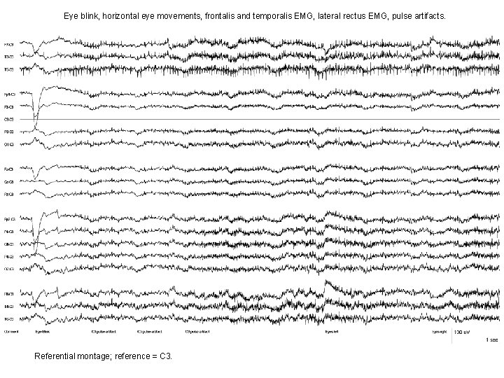 Eye blink, horizontal eye movements, frontalis and temporalis EMG, lateral rectus EMG, pulse artifacts. Eye blink, horizontal eye movements, frontalis and temporalis EMG, lateral rectus EMG, pulse artifacts.