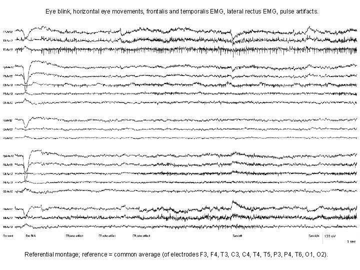 Eye blink, horizontal eye movements, frontalis and temporalis EMG, lateral rectus EMG, pulse artifacts. Eye blink, horizontal eye movements, frontalis and temporalis EMG, lateral rectus EMG, pulse artifacts.