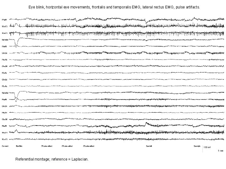 Eye blink, horizontal eye movements, frontalis and temporalis EMG, lateral rectus EMG, pulse artifacts. Eye blink, horizontal eye movements, frontalis and temporalis EMG, lateral rectus EMG, pulse artifacts.