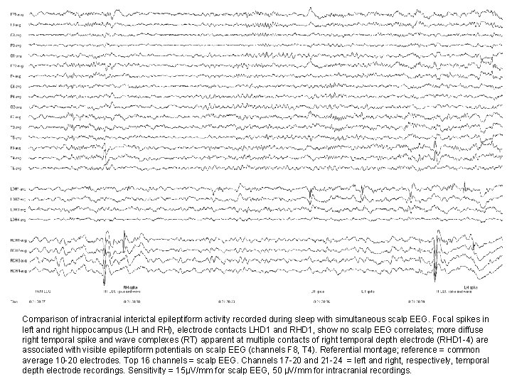 Comparison of intracranial interictal epileptiform activity recorded during sleep with simultaneous scalp EEG. Focal Comparison of intracranial interictal epileptiform activity recorded during sleep with simultaneous scalp EEG. Focal