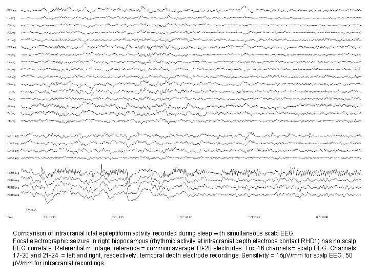 Comparison of intracranial ictal epileptiform activity recorded during sleep with simultaneous scalp EEG. Focal Comparison of intracranial ictal epileptiform activity recorded during sleep with simultaneous scalp EEG. Focal