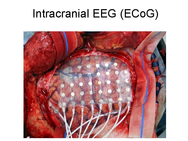 Intracranial EEG (ECo. G) Intracranial EEG (ECo. G)