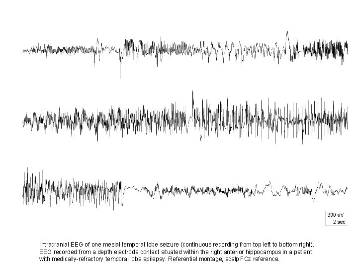Intracranial EEG of one mesial temporal lobe seizure (continuous recording from top left to Intracranial EEG of one mesial temporal lobe seizure (continuous recording from top left to
