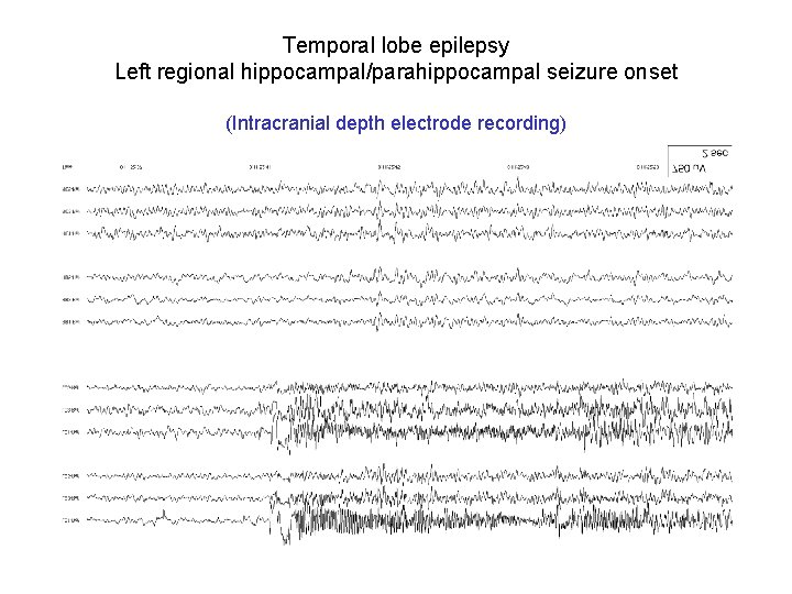 Temporal lobe epilepsy Left regional hippocampal/parahippocampal seizure onset (Intracranial depth electrode recording) Temporal lobe epilepsy Left regional hippocampal/parahippocampal seizure onset (Intracranial depth electrode recording)