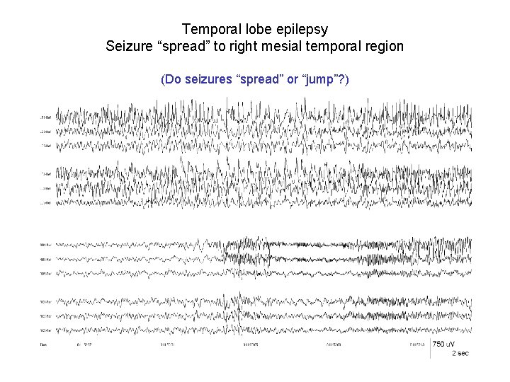 Temporal lobe epilepsy Seizure “spread” to right mesial temporal region (Do seizures “spread” or Temporal lobe epilepsy Seizure “spread” to right mesial temporal region (Do seizures “spread” or