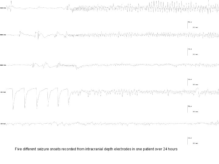 Five different seizure onsets recorded from intracranial depth electrodes in one patient over 24 Five different seizure onsets recorded from intracranial depth electrodes in one patient over 24