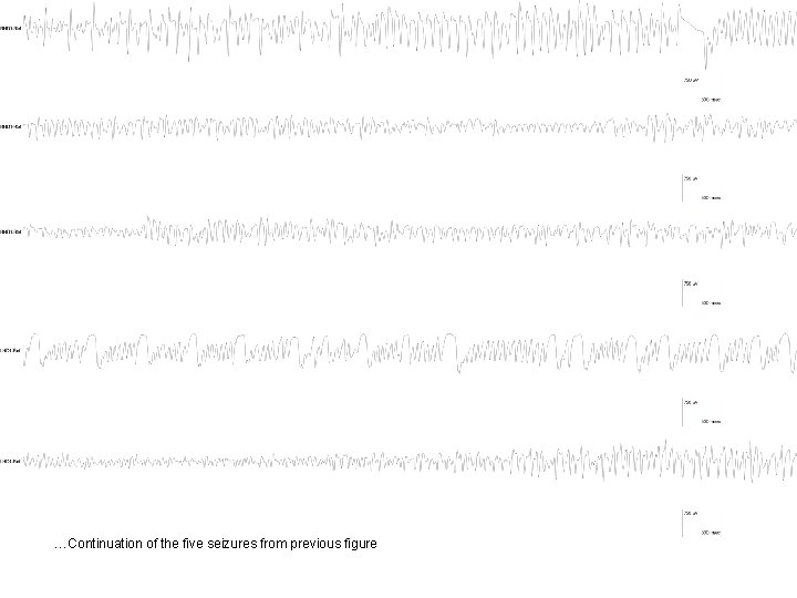 …Continuation of the five seizures from previous figure …Continuation of the five seizures from previous figure