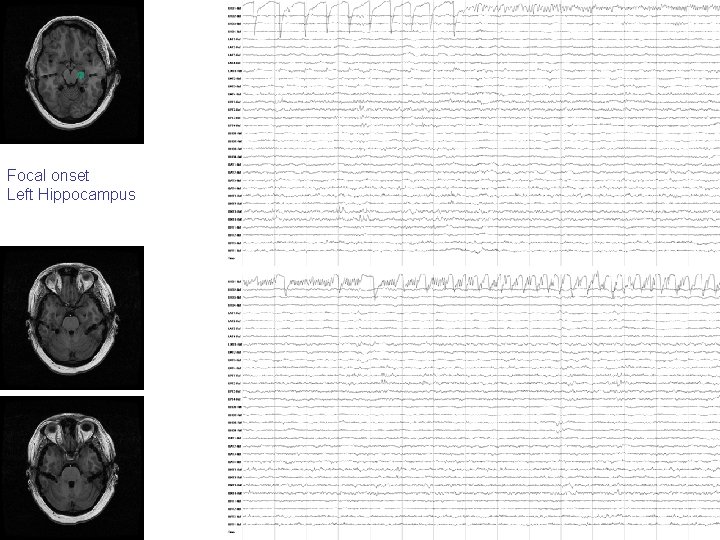 Focal onset Left Hippocampus Focal onset Left Hippocampus