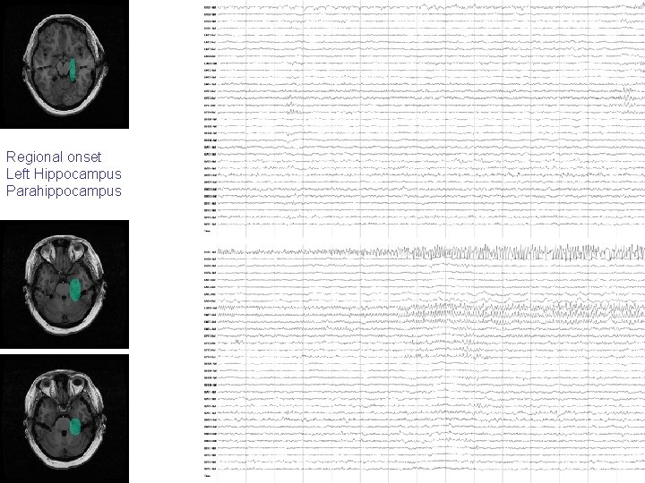 Regional onset Left Hippocampus Parahippocampus Regional onset Left Hippocampus Parahippocampus