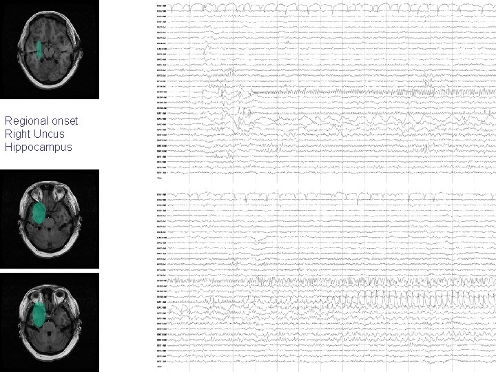 Regional onset Right Uncus Hippocampus Regional onset Right Uncus Hippocampus