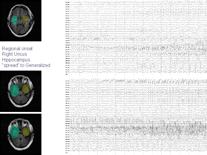 Regional onset Right Uncus Hippocampus “spread” to Generalized Regional onset Right Uncus Hippocampus “spread” to Generalized