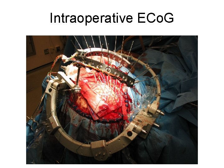 Intraoperative ECo. G Intraoperative ECo. G