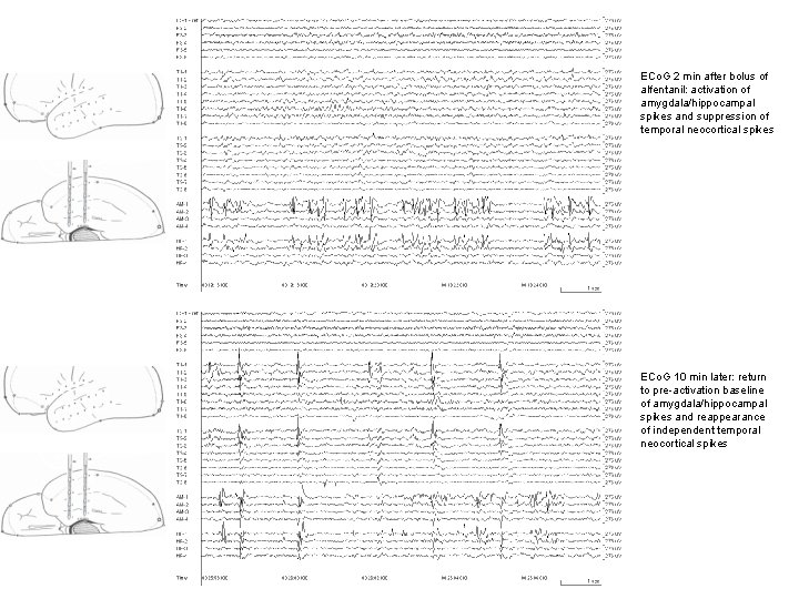 ECo. G 2 min after bolus of alfentanil: activation of amygdala/hippocampal spikes and suppression ECo. G 2 min after bolus of alfentanil: activation of amygdala/hippocampal spikes and suppression