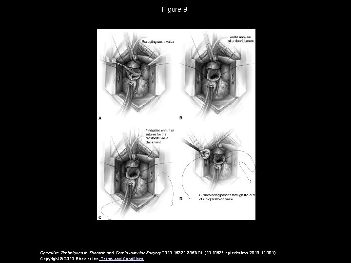 Figure 9 Operative Techniques in Thoracic and Cardiovascular Surgery 2010 15321 -335 DOI: (10.